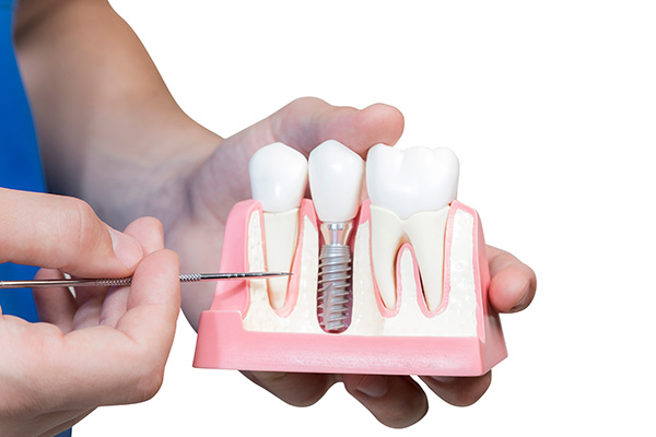 An Implant Dentist Talks About Good Candidates for This Procedure from Gledhill Dental in Kennewick, WA