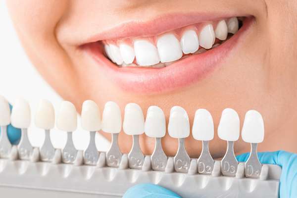 Ask a Cosmetic Dentist: What Are Veneers from Gledhill Dental in Kennewick, WA