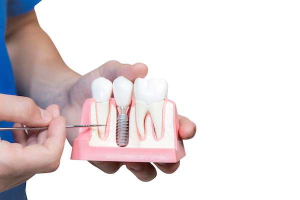 Can You Get Dental Implants if You Have Gum Disease from Gledhill Dental in Kennewick, WA