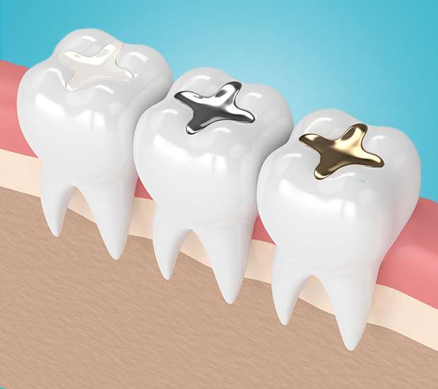 Kennewick Composite Fillings