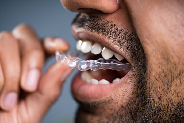 A Cosmetic Dentist Explains Benefits of Clear Aligners from Gledhill Dental in Kennewick, WA