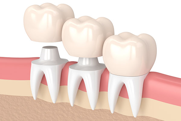 Three Tips to Deal With a Loose Dental Crown from Gledhill Dental in Kennewick, WA