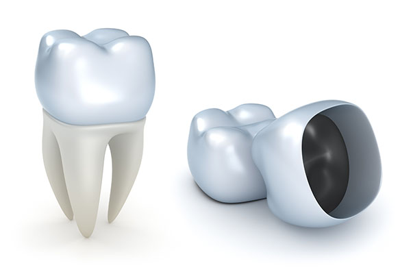 Is a Dental Crown Recommended for Dealing with a Cracked Tooth? from Gledhill Dental in Kennewick, WA