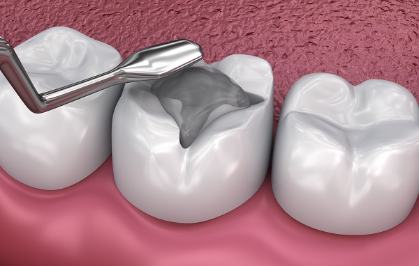 When Is A Dental Filling Necessary?