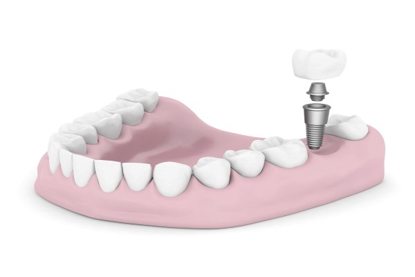 Dental Implants Kennewick, WA