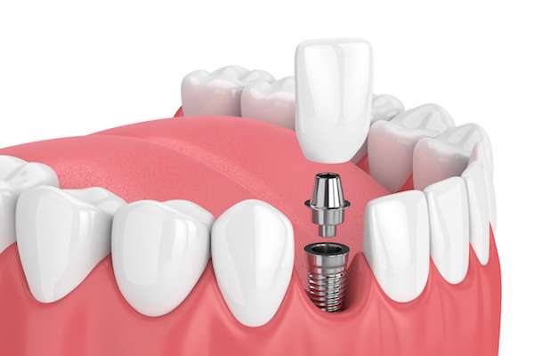 How Painful is Dental Implant Surgery from Gledhill Dental in Kennewick, WA