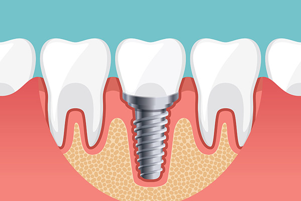 Implant Dentistry Options To Replace a Single Missing Tooth from Gledhill Dental in Kennewick, WA