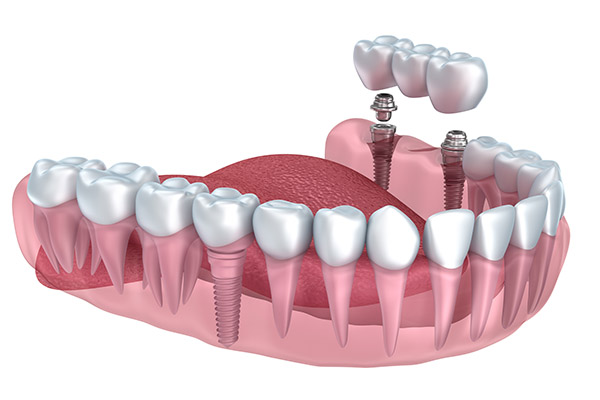 Implant Dentistry Supported Bridge from Gledhill Dental in Kennewick, WA