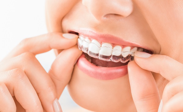 Invisalign Kennewick, WA