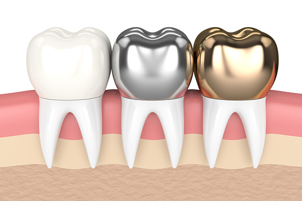 Metal Crowns vs. Porcelain Dental Crowns from Gledhill Dental in Kennewick, WA