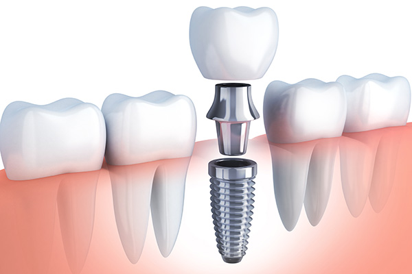 Questions to Ask Your Implant Dentist from Gledhill Dental in Kennewick, WA