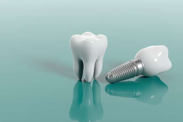 Multiple Teeth Replacement Options: One Implant for Two Teeth from Gledhill Dental in Kennewick, WA