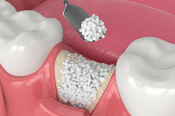 When a Bone Graft Is Needed for an Implant Dentistry Procedure from Gledhill Dental in Kennewick, WA