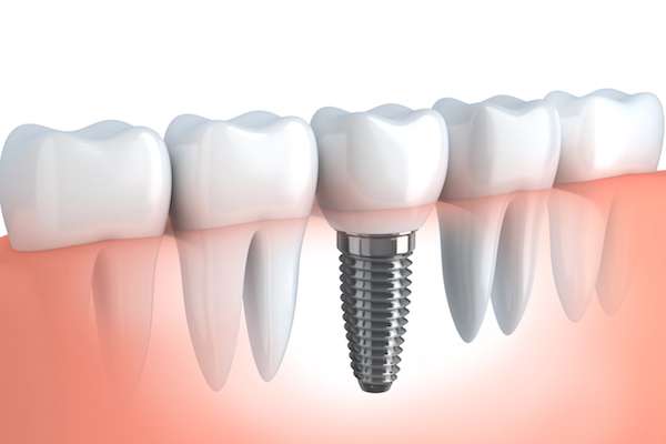 Your Ultimate Guide to Getting Dental Implants from Gledhill Dental in Kennewick, WA